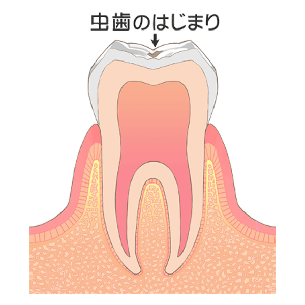 Ｃ１：歯の表層（エナメル質）の虫歯
