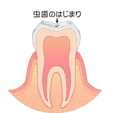 脱灰
