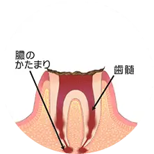 歯の根まで達した虫歯