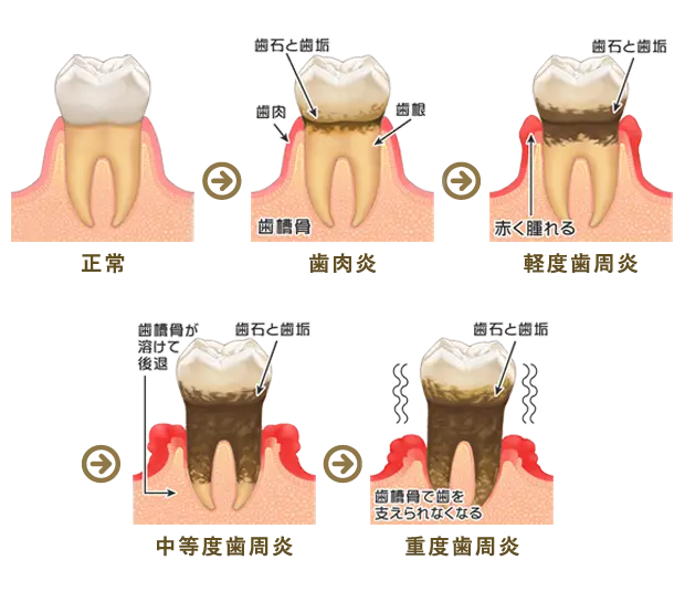 歯周病治療