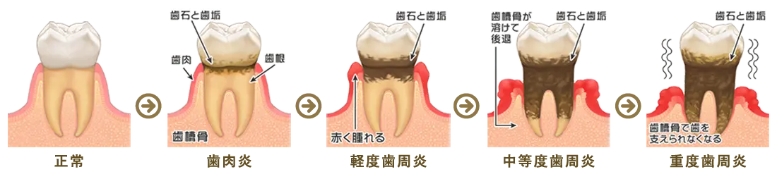 歯周病治療