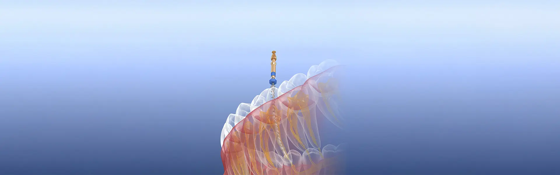 根管治療